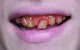 Hillbilly Custom Denture Hillbilly Custom Denture